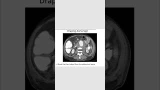 Draping aorta signradiology inicet neetpg shortsfeed [upl. by Anivlis]