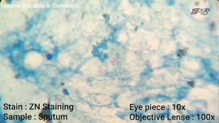 Microscopic Slide Quiz for practice  Sputum for AFB acid fast bacilli test slide with ZN staining [upl. by Underwood]