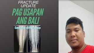 FRACTURE UPDATE PAG USAPAN ANG BALI [upl. by Hobbs]