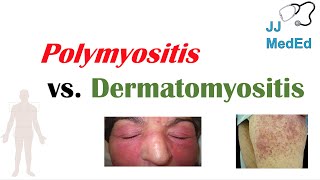 Idiopathic Inflammatory Myopathies  Polymyositis vs Dermatomyositis [upl. by Perl522]