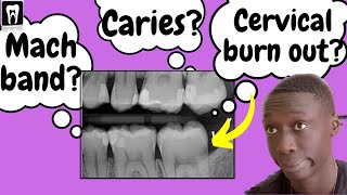 Caries Vs Cervical burnout Vs Mach band effect  Interpretation of Dental Caries [upl. by Gordan]