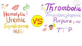 Hemolytic Uremic Syndrome HUS vs Thrombotic Thrombocytopenic purpura TTP [upl. by Lesig]