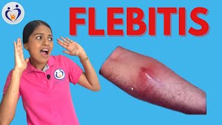 FLEBITIS [upl. by Ardnasela]