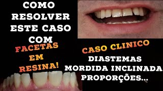 🛑Planejamento e diagnóstico para FACETAS EM RESINA CASO CLÍNICO COM DIASTEMASMORDIDA INCLINADA🤫 [upl. by Cilka]