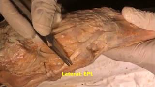 Forearm ExtensorAnatomical SnuffboxHand Dissection  Sanjoy Sanyal [upl. by Yrhcaz]