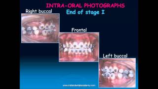 beggs technique part  orthodontic courses by Indian dental academy [upl. by Anyal]