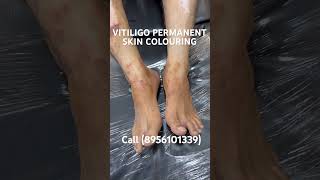 VITILIGO PERMANENT SKIN COLOURING  safeddaag ilaj  treatment  vitiligocures micropigmentation [upl. by Codee]