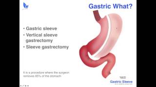 Gastric Sleeve Surgery by Dr Guillermo Alvarez  Webinar  Weight Loss [upl. by Eemak261]