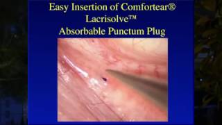 Inserting the Comfortear® Lacrisolve® 180 Absorbable Punctum Plug [upl. by Shantee333]