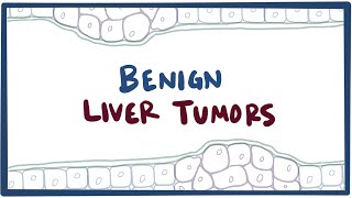 Benign liver tumors  causes symptoms diagnosis treatment amp pathology [upl. by Ulysses]