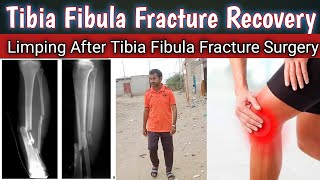 Limping After Tibia Fibula Fracture SurgeryTibia Fibula Fracture RecoveryLimping Kab Tak Thik Huga [upl. by Tabor]