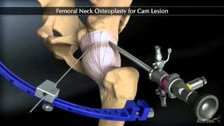 Osteoplasti e Qafës Femorale Femoral Neck Osteoplasty for Cam Lesion [upl. by Loris]