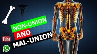 Orthopedics  NONUNION amp MALUNION FMGENEETPG [upl. by Annoik]