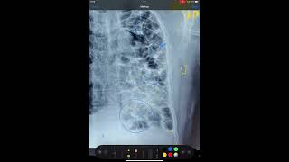 BRONCHIECTASIS FIBROSIS OF LUNGS MEDIASTINAL SHIFT X RAY CHEST [upl. by Hotchkiss]