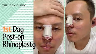 Rhinoplasty In the Philippines 1st Day Post Opp [upl. by Yeslah246]