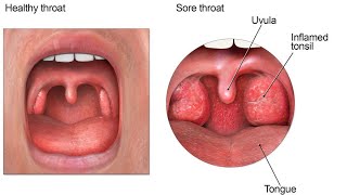 The modified Centor Score  McIsaac score for GAS pharyngitis [upl. by Donn]