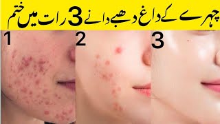 Whitehead blackhead removal at home  acne treatment at home remedy  acne treatment at home [upl. by Dorren503]