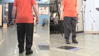 Functional Ambulation Patient With Orthoses [upl. by Davine]