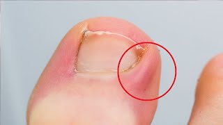 ingrown toenail home treatment dental floss fast [upl. by Ammeg]