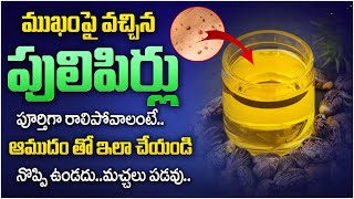 నొప్పి లేకుండా పులిపిర్లు మాయం  Home Remedies For Pulipirlu  Warts on Face and Neck  Dhatri TV [upl. by Bay543]