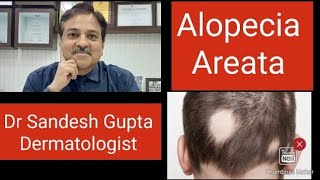 Alopecia areata को कैसे ठीक करें  9990804085 जानिए Dermatologist Dr Sandesh Gupta से। [upl. by Noryv947]