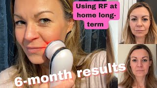 Sixmonth Lumo radiofrequency results and how to use RF devices cautiously longterm [upl. by Elder]