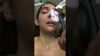 Removing a Nasal Stent 5 Days after Rhinoplasty [upl. by Anecusa]