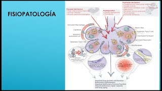 Displasia broncopulmonar y sepsis neonatal [upl. by Booth]