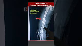 Thigh Bone Femur Fracture Xray xray radiology radiography bones Fracture radiographerusn [upl. by Noyk676]