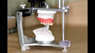 Clinical Remount of Complete Dentures [upl. by Aerahs353]