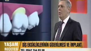 implant fiyatları nasıldır  implant nedir ve İmplant bakımı nasıl olmalıdır  Tanfer Klinik [upl. by Brown]