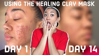 I Used The Healing Clay Mask EVERYDAY CRAZY RESULTS  How Bentonite Clay Cleared My Acne [upl. by Korman]