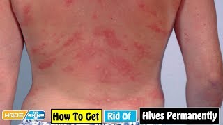 How to Get Rid of Hives Permanently  Home Remedies For Hives Symptoms [upl. by Watters]