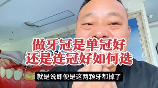 去医院做牙冠是做单冠还是连冠，该如何选，有哪些后顾之忧？ [upl. by Steinway]