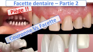 Facette dentaire  Facette Vs Couronnes Piège à éviter  Guide complet  partie 2 [upl. by Augie]