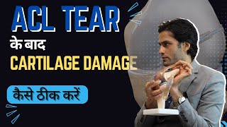 ACL Tear के बाद Cartilage damage कैसे ठीक करें [upl. by Dub650]