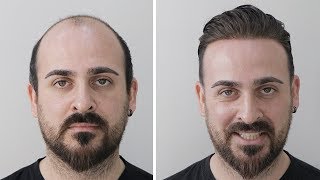 PROTEZ SAÇ Ünlü Youtuber Aras Karafil e PROTEZ SAÇ UYGULADIK Hair Replacement [upl. by Harol74]