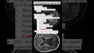 Frontotemporal dementia [upl. by Eirrot]