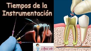 ENDODONCIA  Tiempos de la Instrumentación  Exploración Cateterismo Neutralización [upl. by Harry]