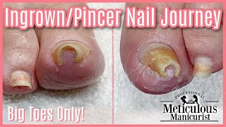 👣Big Toes Only  IngrownPincer Impacted Toenail Pedicure Transformation👣 [upl. by Smiga123]