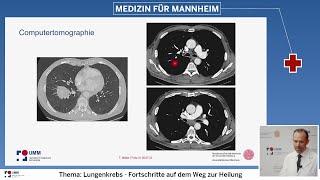 Vom Röntgenbild bis zur Therapie  moderne Diagnostik bei Lungenkrebs [upl. by Nit855]