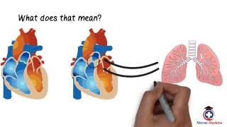 Tetralogy of Fallot [upl. by Ryder]