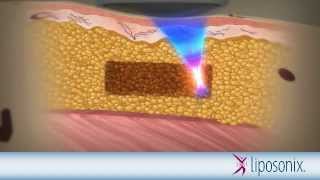 Liposonix Mechanism of Action Animation [upl. by Iverson]