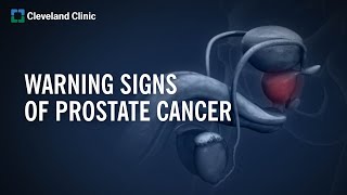 10 Warning Signs of Prostate Cancer [upl. by Erastatus381]