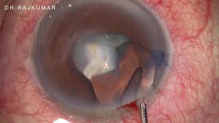 PHACOEMULSIFICATION FOR COMPLICATED CATARACT WITH ADHERENT LEUCOMAUN EDITED VIDEO IN 2X SPEED [upl. by Giralda]