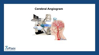 Cerebral Angiogram [upl. by Cinemod]