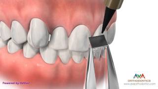 Putting Braces On or Bonding  Direct Technique [upl. by Nikaniki]