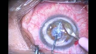 DALK QUERATOPLASTIA LAMELAR ANTERIOR PROFUNDA [upl. by Milstone479]