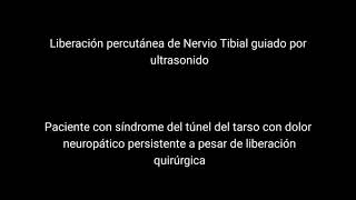 Liberación percutánea de nervio tibial guiado por ultrasonido [upl. by Zucker]