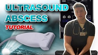 Ultrasound Guided Abscess Drainage [upl. by Dorcy]